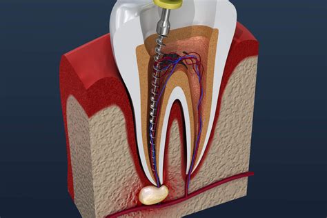 root canal-4